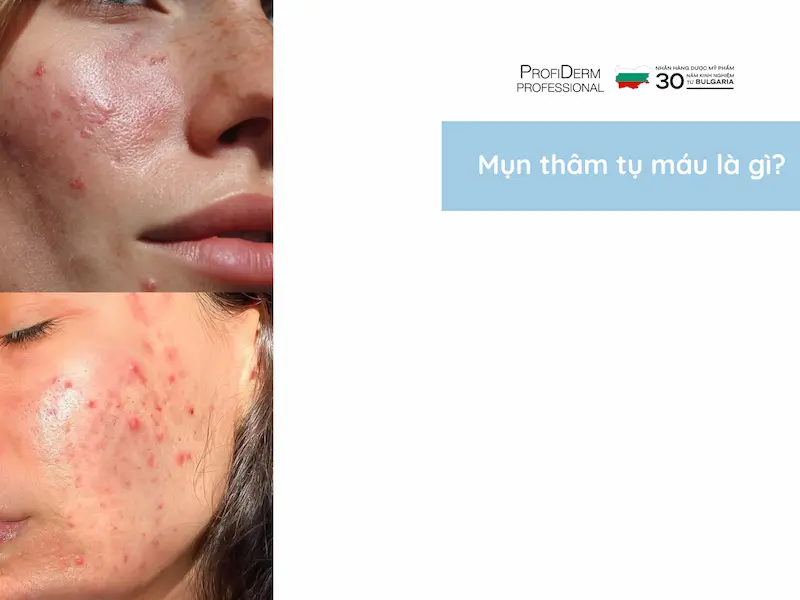 mụn thâm tụ máu mụn thâm tụ máu