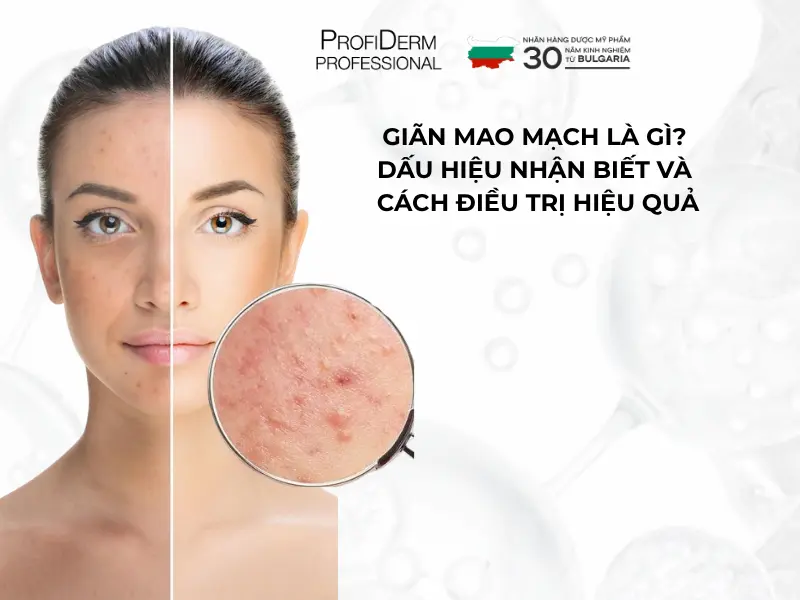 giãn mao mạch giãn mao mạch