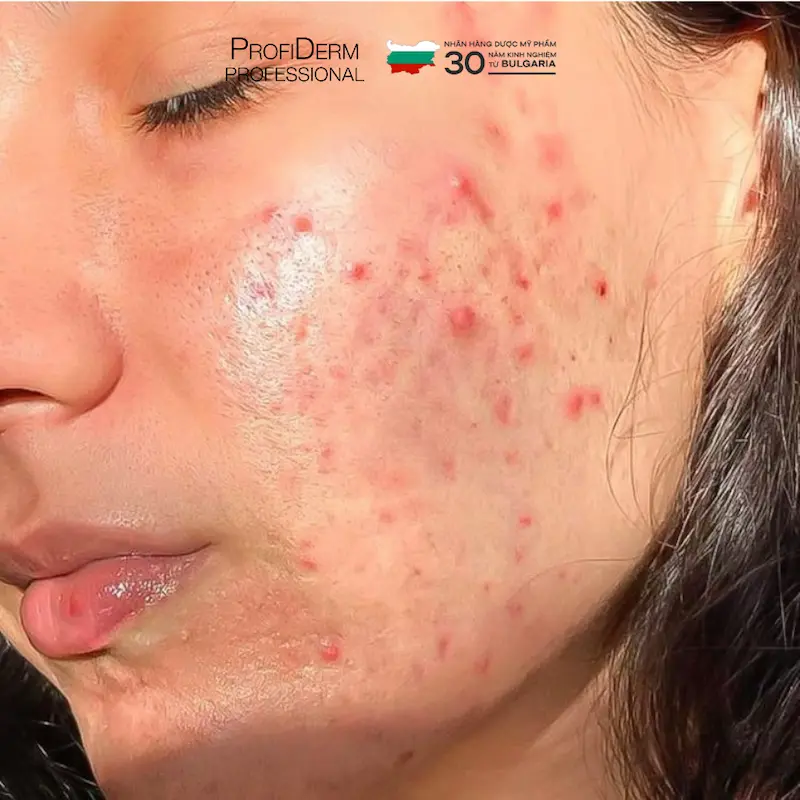 cách phục hồi da bị dị ứng mỹ phẩm cách phục hồi da bị dị ứng mỹ phẩm