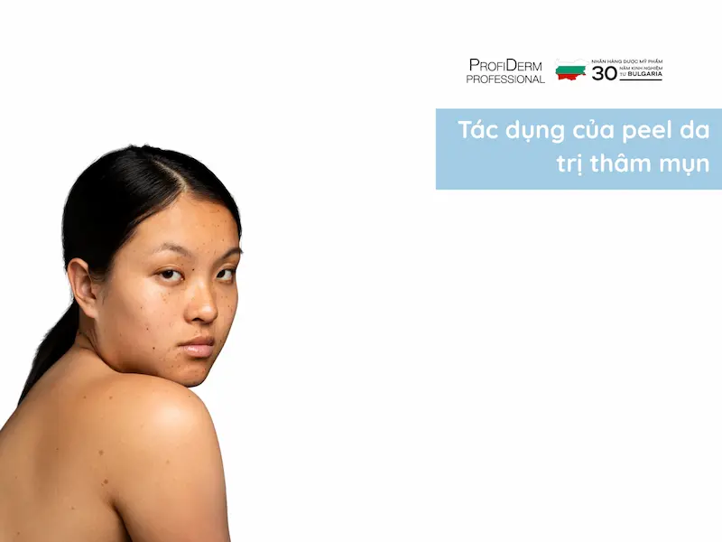 Tác Dụng Của Peel Da Trị Thâm Mụn Tác Dụng Của Peel Da Trị Thâm Mụn