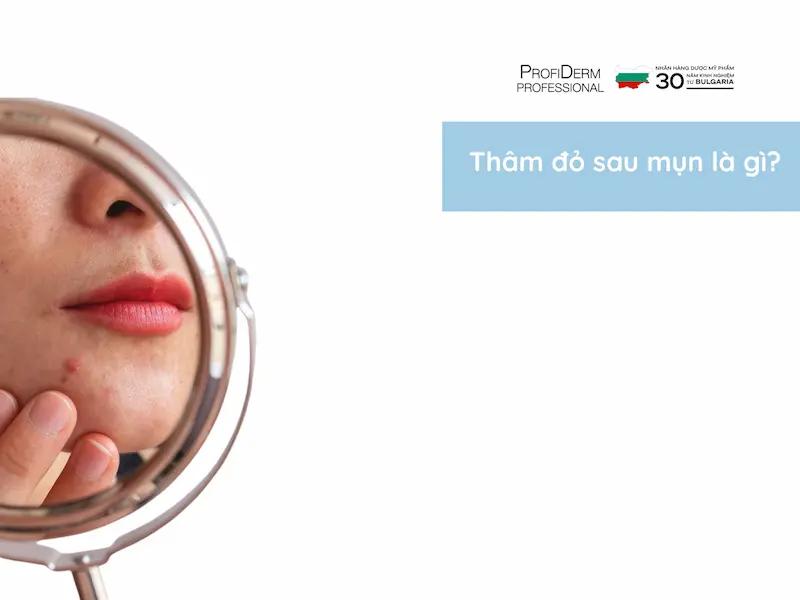 thâm đỏ sau mụn thâm đỏ sau mụn