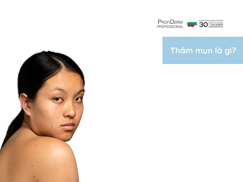 thâm mụn thâm mụn