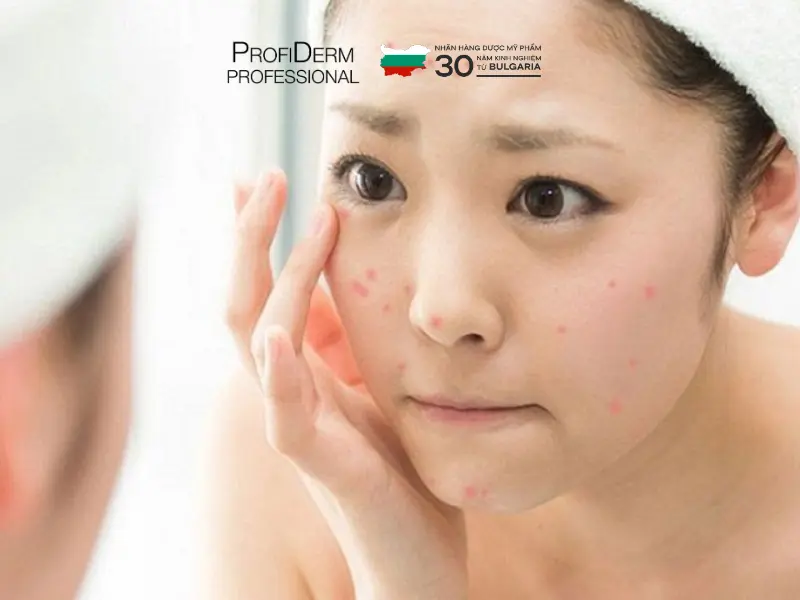 cách phục hồi da bị dị ứng mỹ phẩm cách phục hồi da bị dị ứng mỹ phẩm