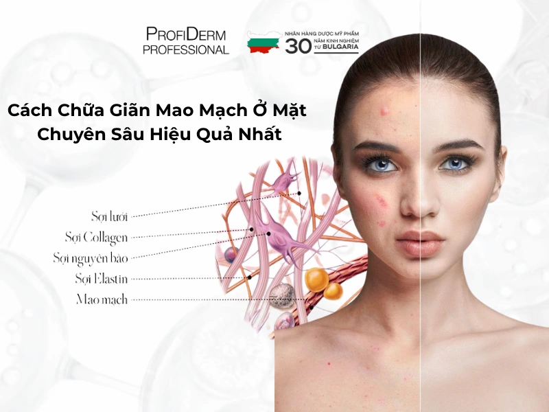 cách chữa giãn mao mạch ở mặt cách chữa giãn mao mạch ở mặt