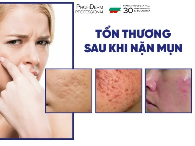 phục hồi da sau nặn mụn phục hồi da sau nặn mụn