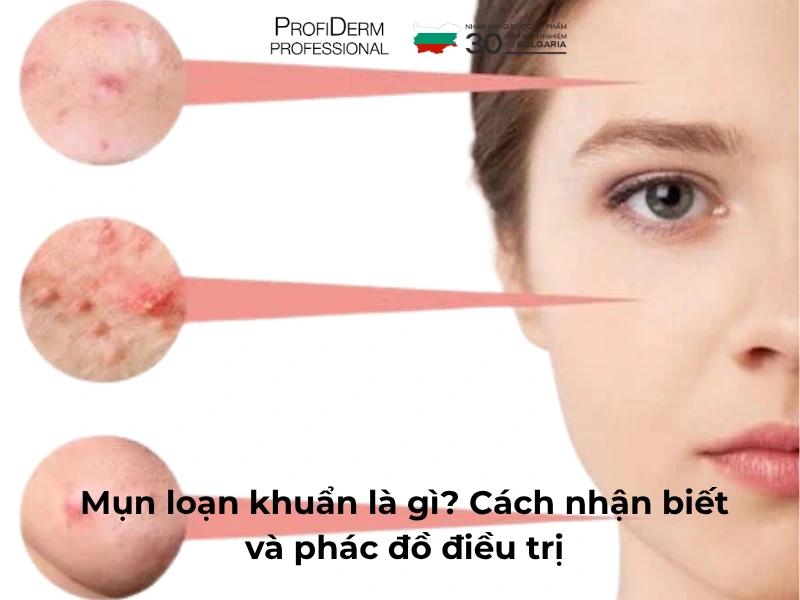 mụn loạn khuẩn mụn loạn khuẩn