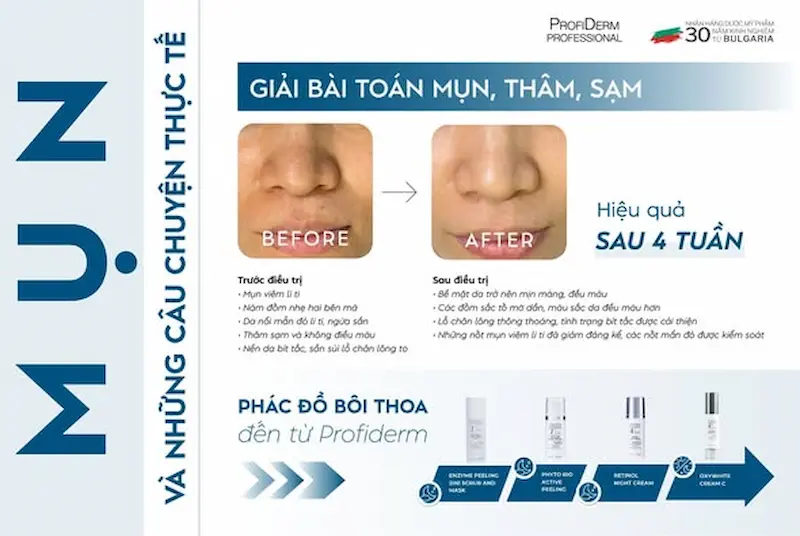 Khách hàng Profiderm điều trị PIE Khách hàng Profiderm điều trị PIE